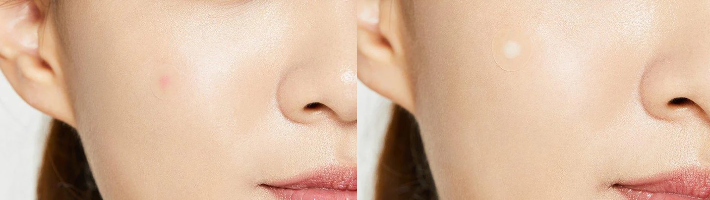 COSRX Acne Pimple Master Patch gyógyító tapaszok 24 db