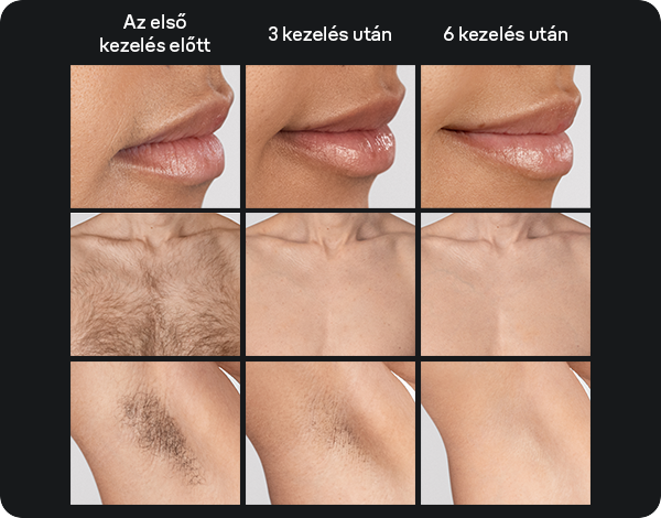 Braun Smart IPL Skin i·expert 7 PL7321 IPL szőrtelenítő